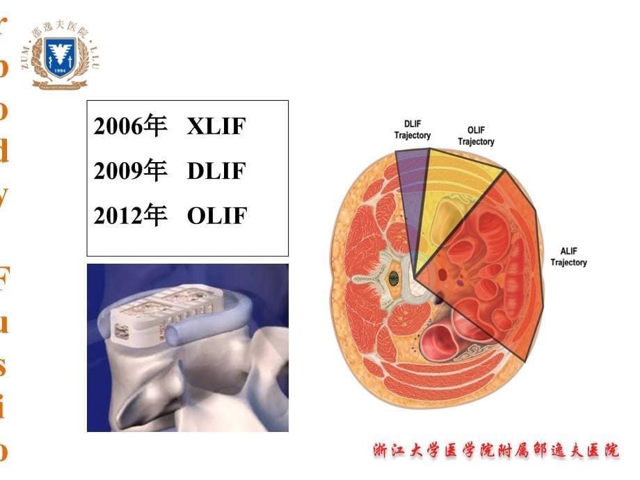 OLIF入路和相关解剖_第5页