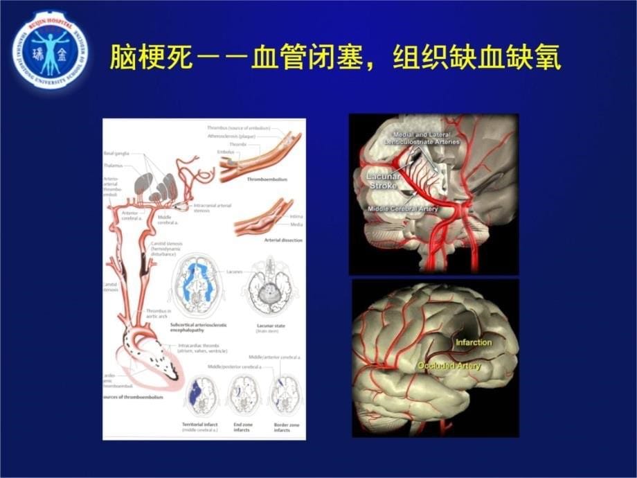 TXL-脑血管教学教材_第5页