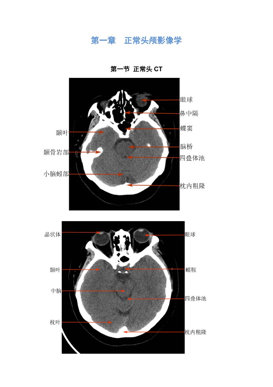 《神经病学》八年制教材 影像图谱.doc_第2页