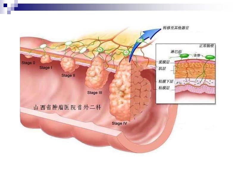 直肠癌新分期教学幻灯片_第4页