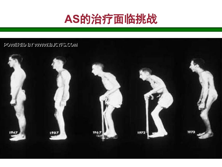 益赛普治疗强直性脊柱炎讲义资料_第2页