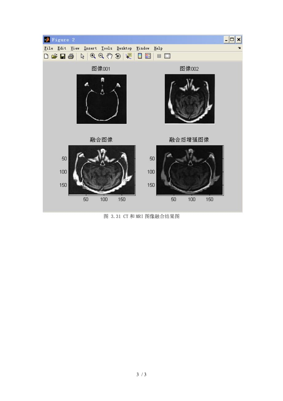 CT与MRI图像融合matlab程序及结果_第3页