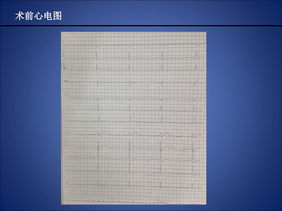 永存左上腔起搏器植入术教学教案_第3页