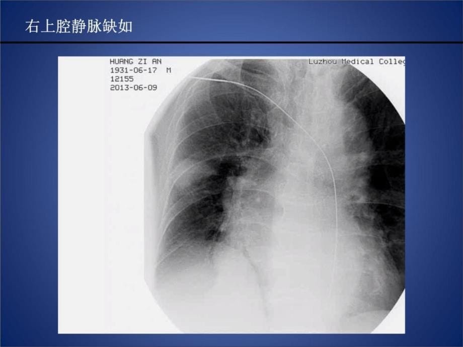 永存左上腔起搏器植入术教学教案_第5页