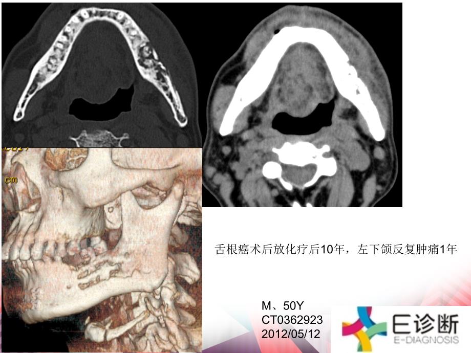 医学影像-颌骨放射性骨坏死的CT表现讲义资料_第1页