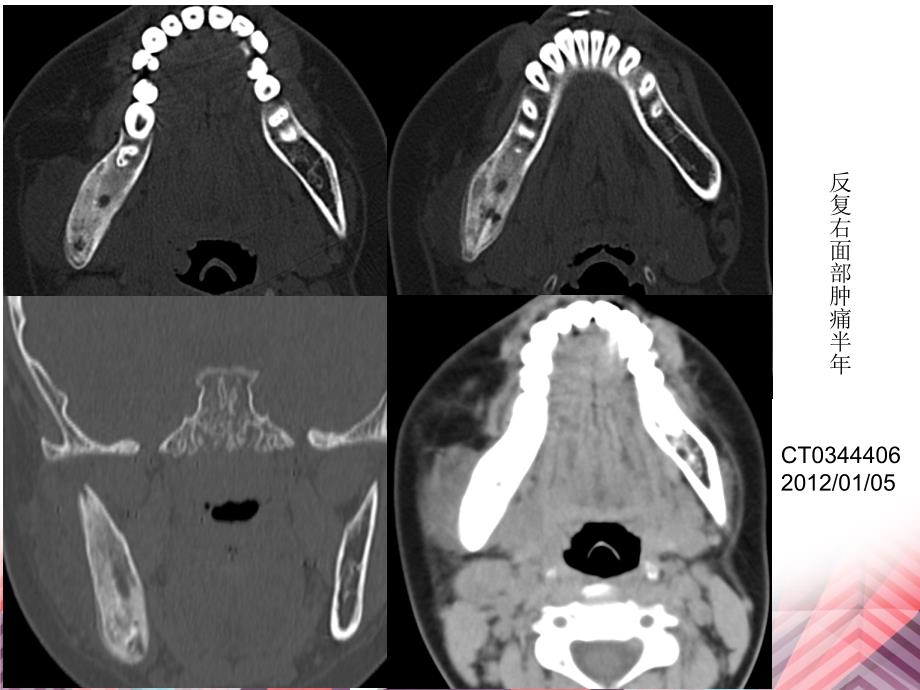 医学影像-颌骨放射性骨坏死的CT表现讲义资料_第2页