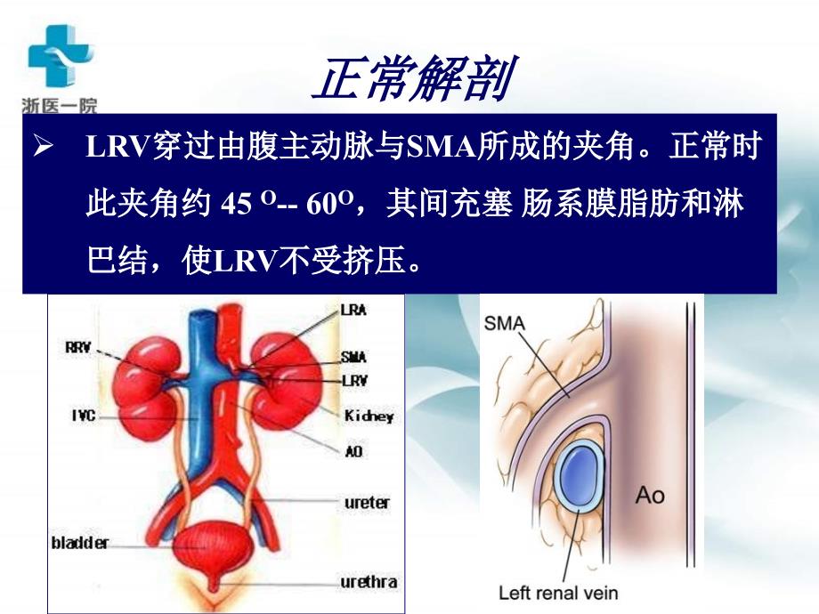 胡桃夹综合征的治疗教程教案_第3页