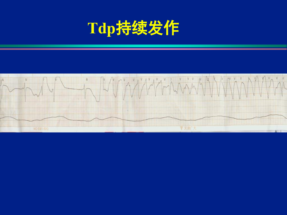 尖端扭转性室性心动过速的机制及治疗策略 (2)_第4页