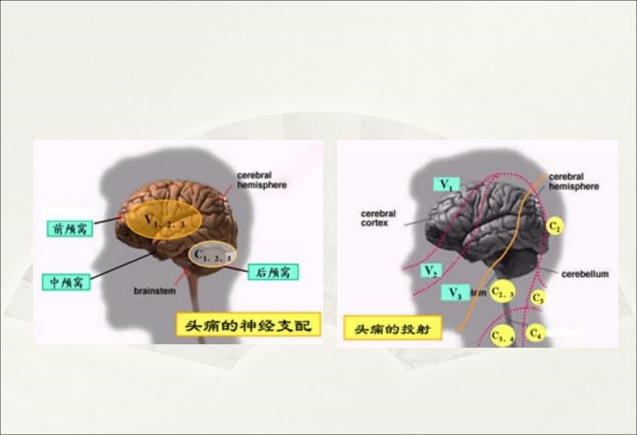 《指南偏头痛》课件_第5页