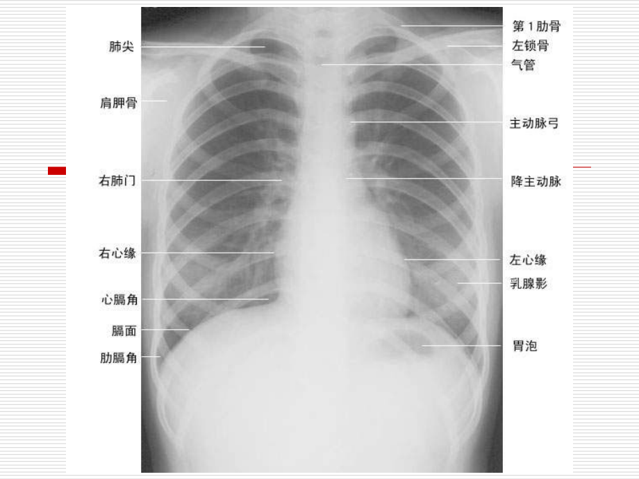 常见的X线和CT诊断-课件(头-胸、腹、四肢)-培训讲座_第4页