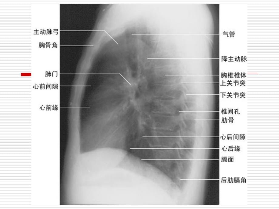 常见的X线和CT诊断-课件(头-胸、腹、四肢)-培训讲座_第5页