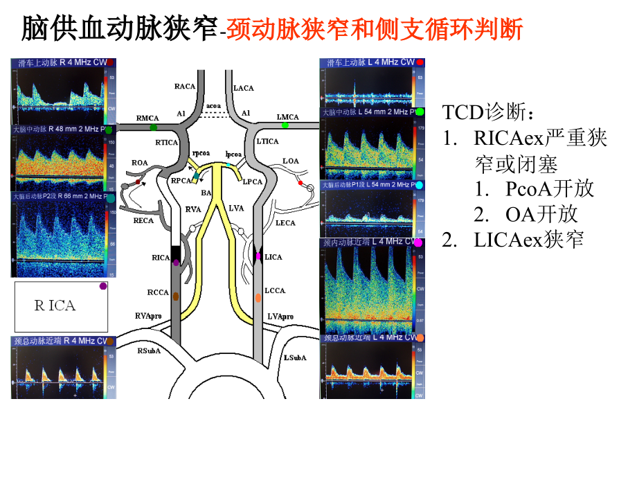 经颅多谱勒超声-(TCD)_第4页