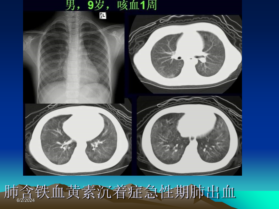 2018年胸部少见疾病影像诊断课件资料_第1页