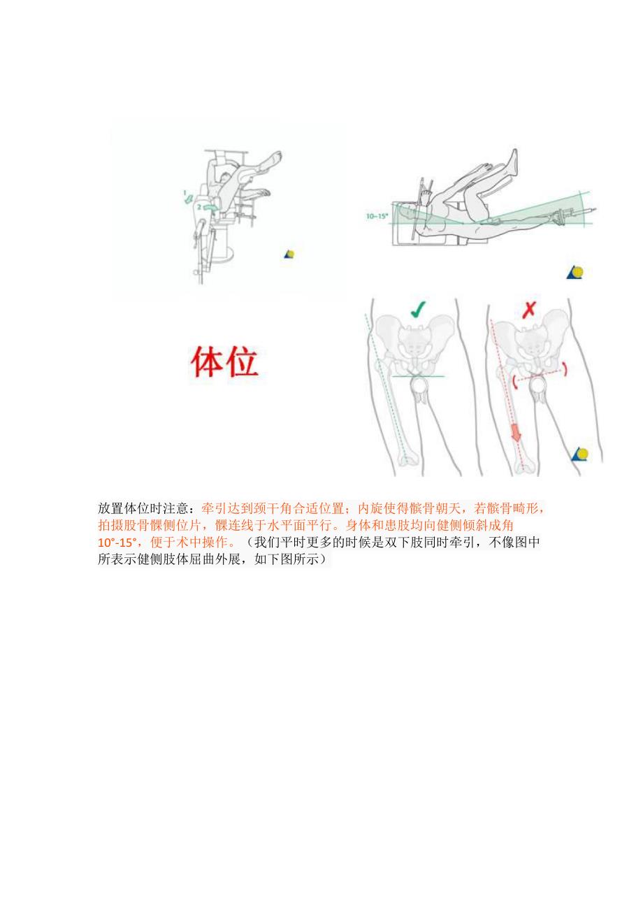 PFNA内固定治疗股骨粗隆间骨折的手术技巧.pdf_第3页