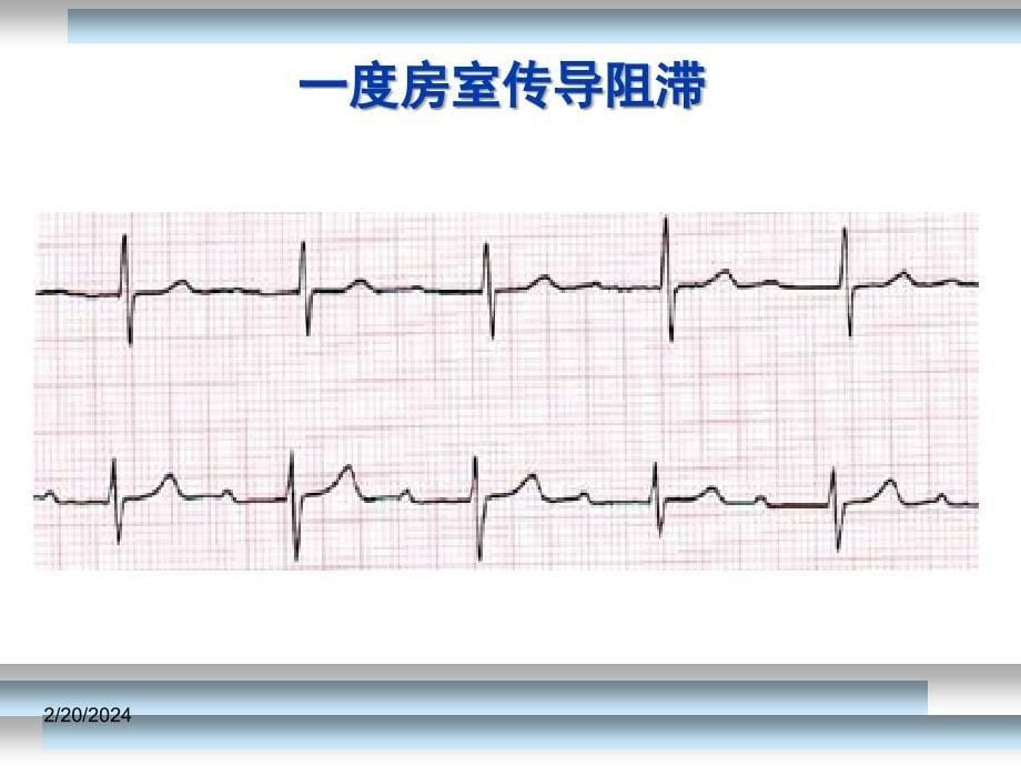 心律失常-教学课件(三)_第5页