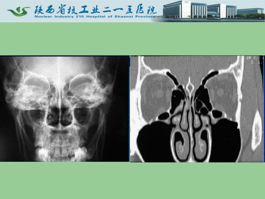 头颈部影诊断课件资料_第4页