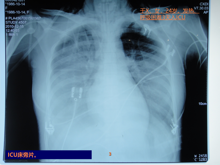 《系统整合临床医学-四川大学》2015年春季-呼吸衰竭ppt课件_第3页