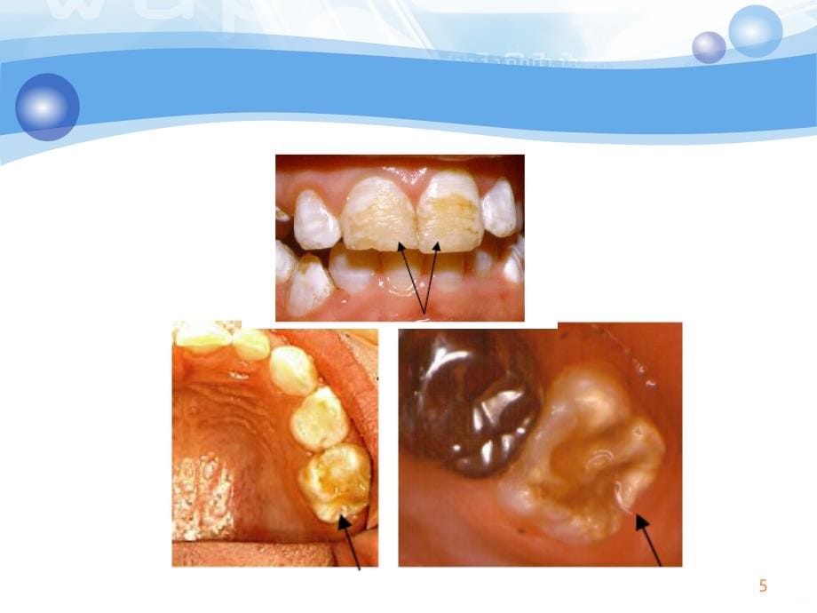 《牙体牙髓》10.10牙体牙髓病ppt课件_第5页