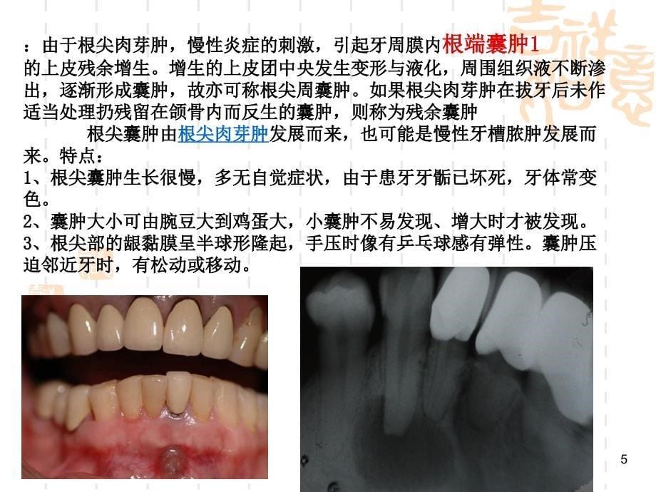 颌骨囊肿业务学习PPT幻灯片课件_第5页