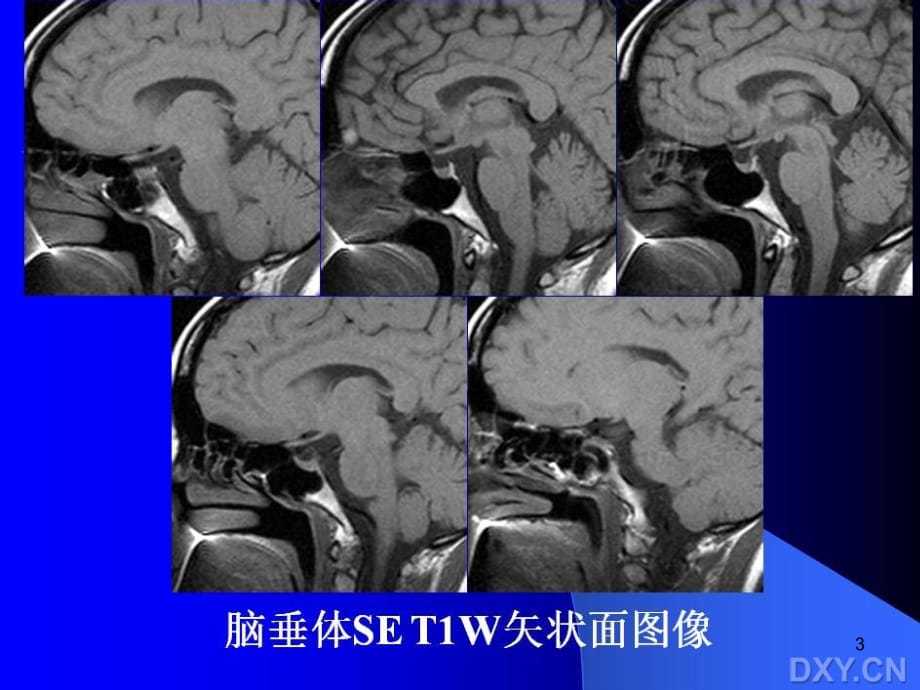 垂体瘤MR表现PPT幻灯片课件_第3页