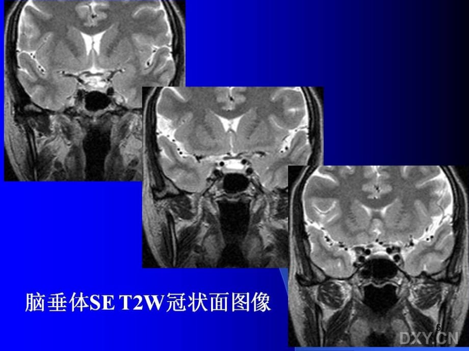 垂体瘤MR表现PPT幻灯片课件_第5页