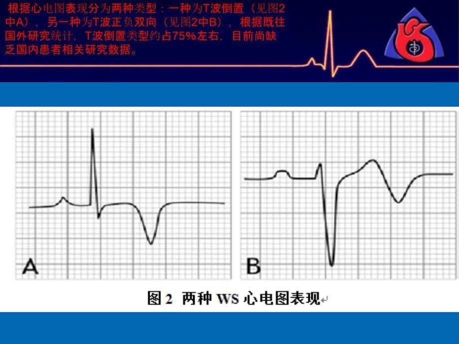 ACS相关的特殊心电图表现PPT课件_第5页