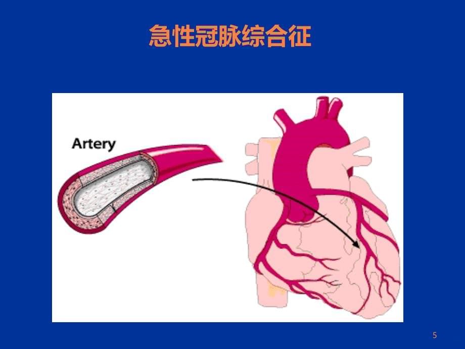 B阻滞剂与冠心病治疗ppt课件_第5页