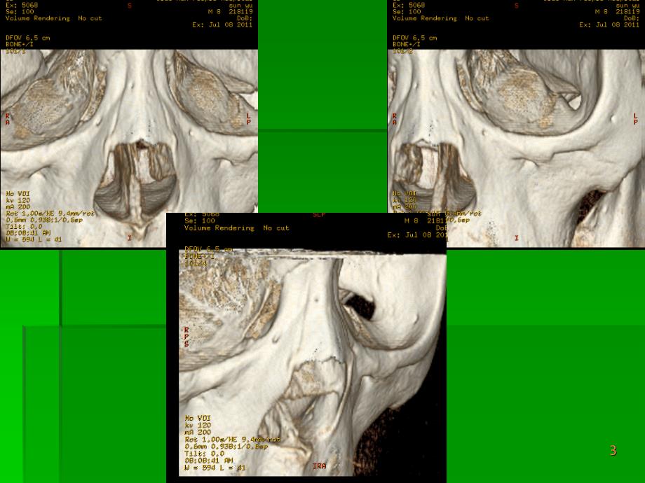 鼻骨解剖与骨折的CT表现ppt课件_第3页
