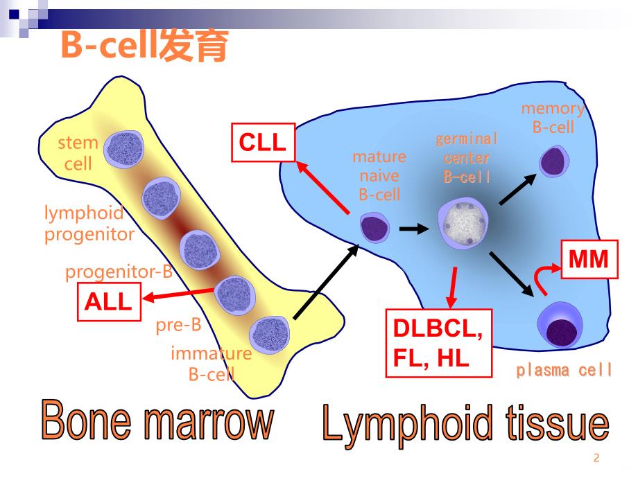 B淋巴细胞增殖性疾病鉴别诊断ppt课件_第2页