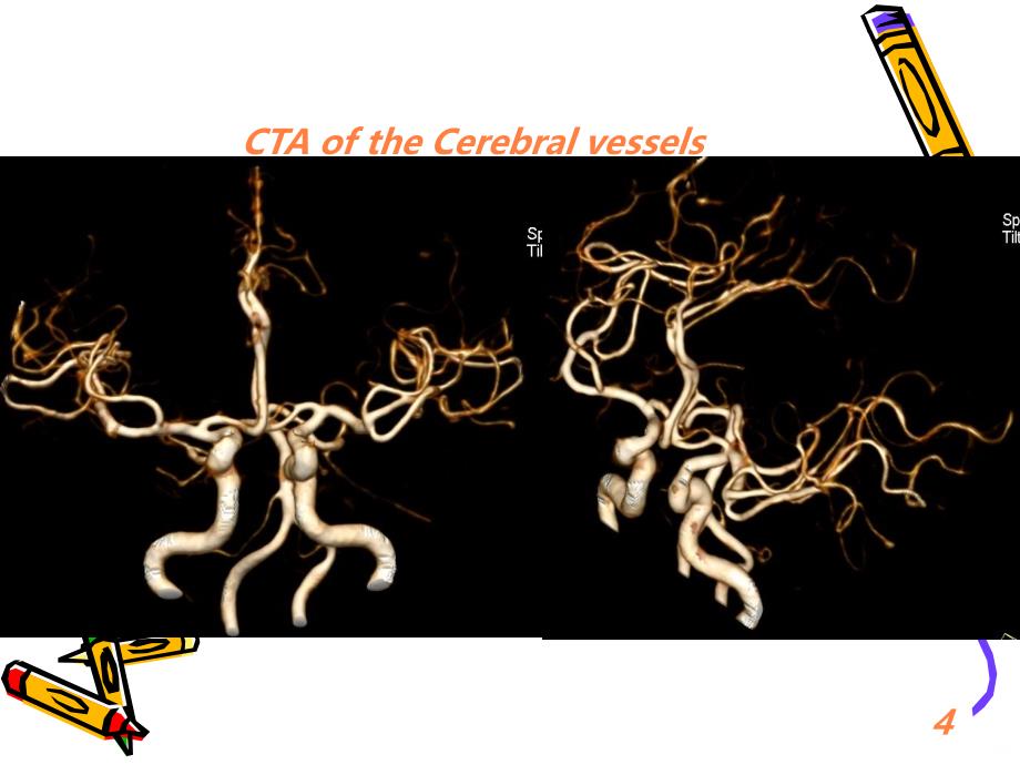 CT临床应用PPT课件_第4页