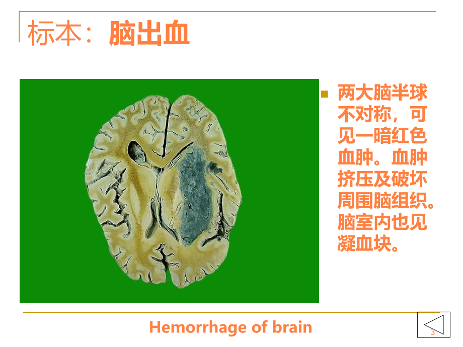 病理学实验大体标本+有病理诊断ppt课件_第3页