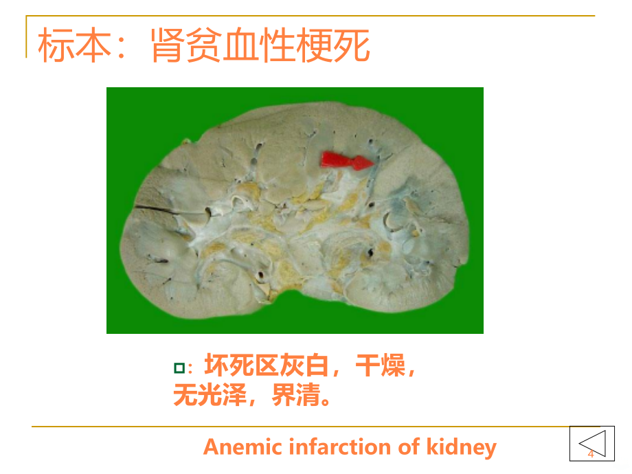 病理学实验大体标本+有病理诊断ppt课件_第4页