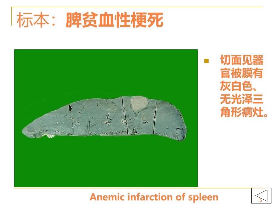 病理学实验大体标本+有病理诊断ppt课件_第5页