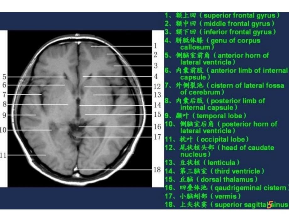 MRI常用解剖PPT课件_第5页