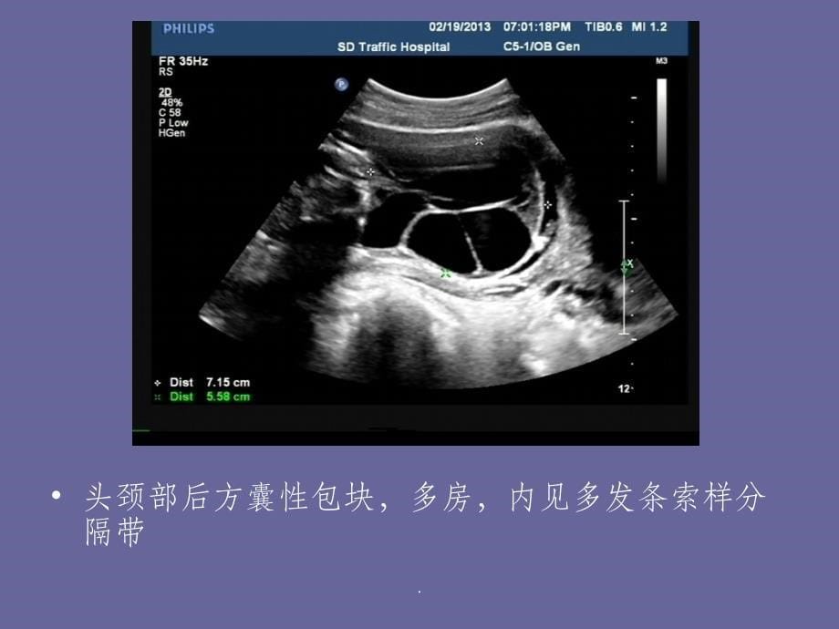 超声诊断胎儿颈部淋巴水囊瘤一例PPT课件_第5页