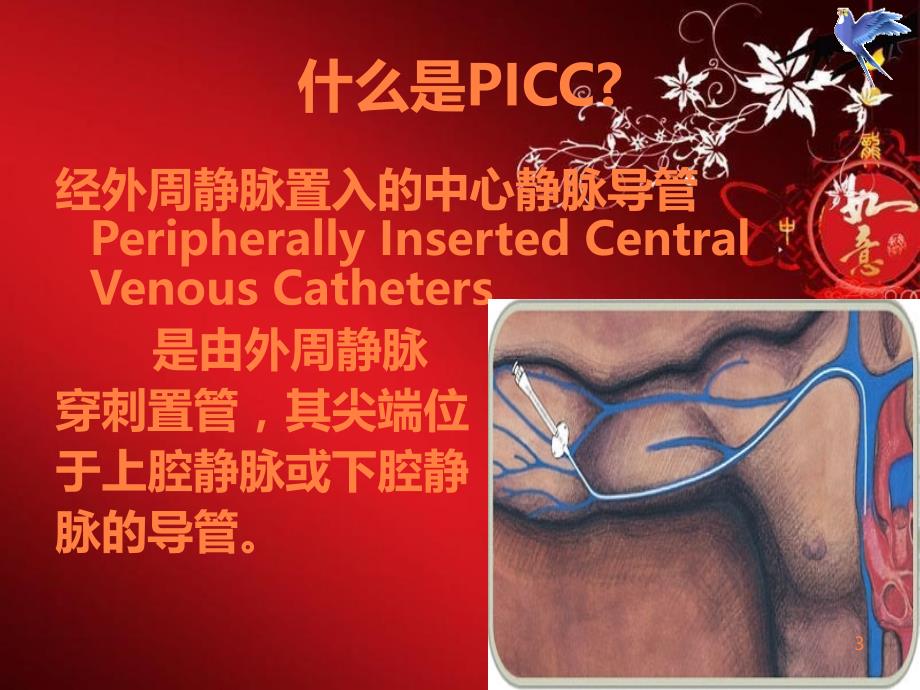 PICC常见并发症及处理护理查房ppt课件_第3页