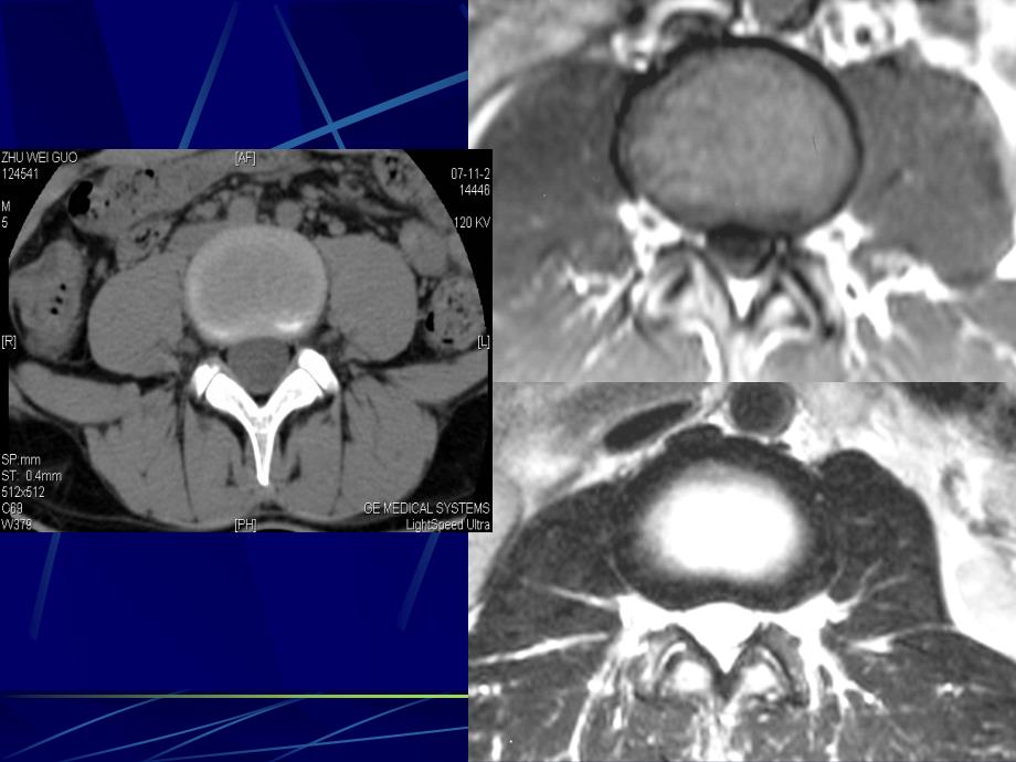 腰椎影像解剖及常见病变ppt课件_第4页