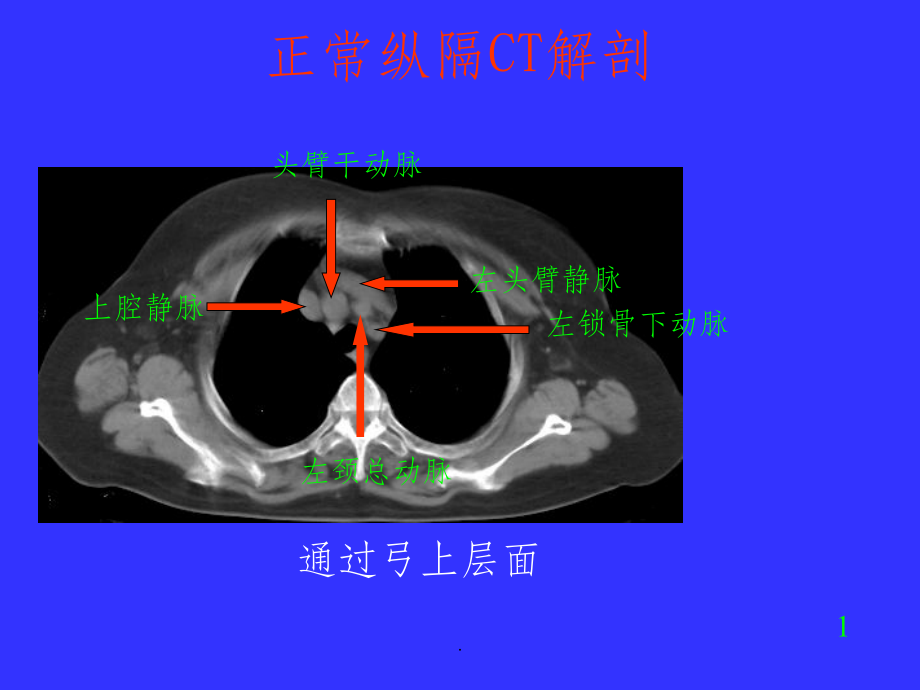 胸部CT诊断19617ppt课件_第3页