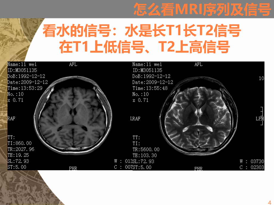 mri的诊断与临床PPT课件_第4页