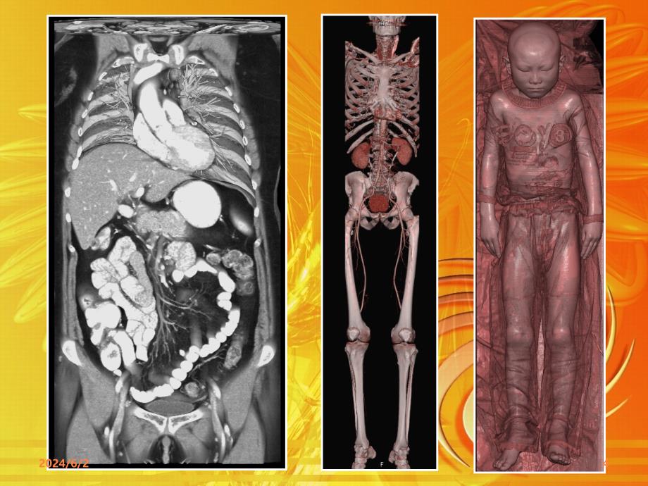 层螺旋CT的临床 ()ppt课件_第4页