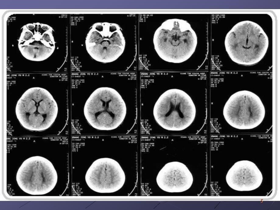 颅脑CT层面解剖PPT课件_第5页