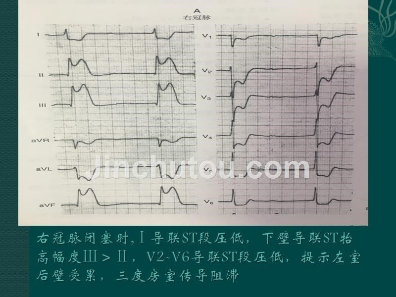 急性右冠、回旋支病变心梗心电图.ppt_第5页