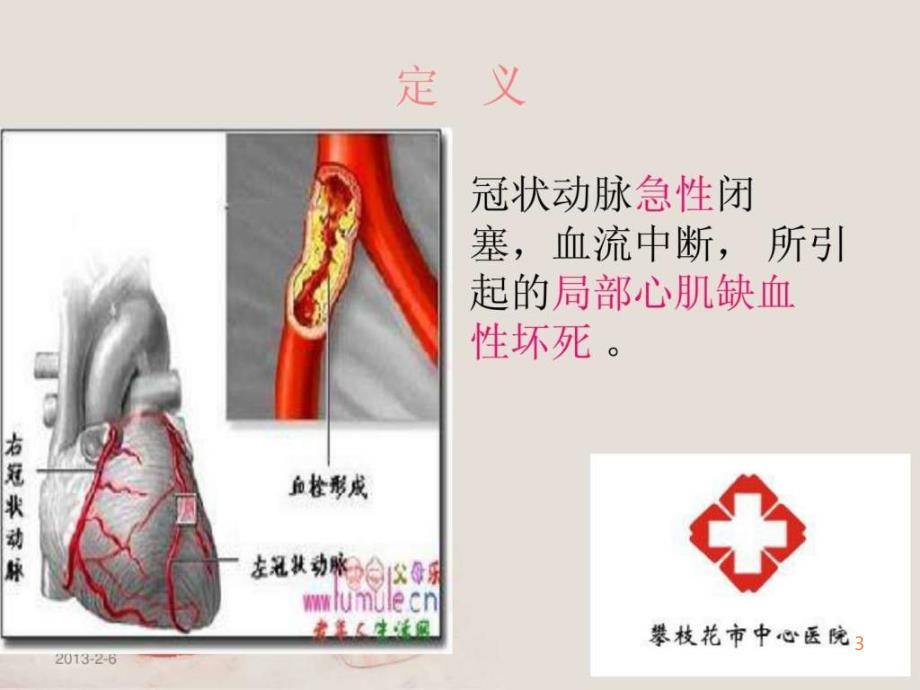 急性心肌梗死的护理查房 槿庭ppt课件_第3页