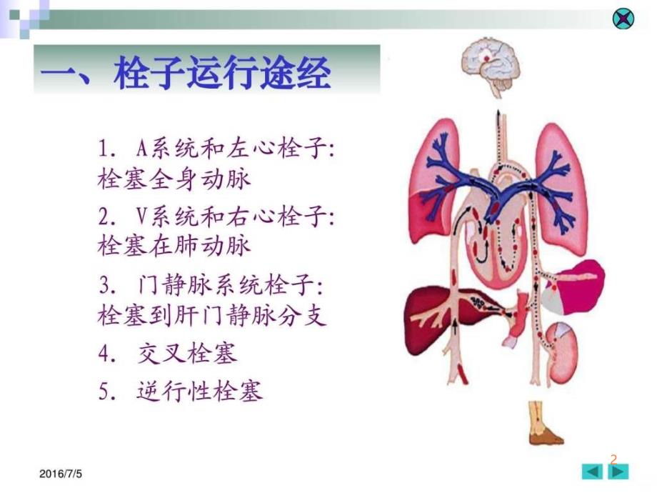 局部血液循环障碍(2)ppt课件_第2页