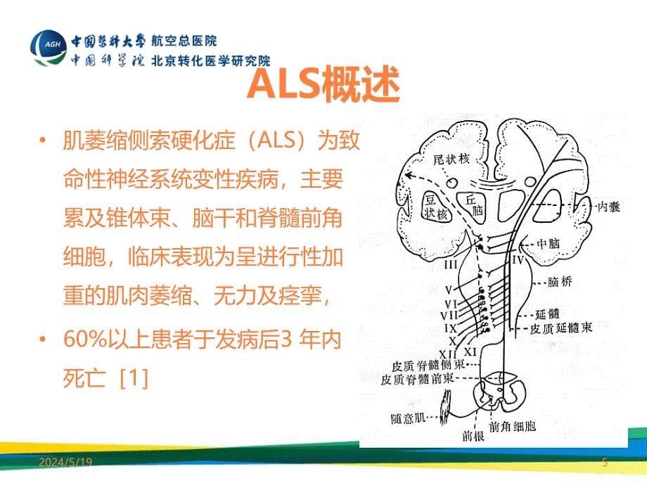 肌萎缩侧索硬化临床诊断进展ppt课件_第5页