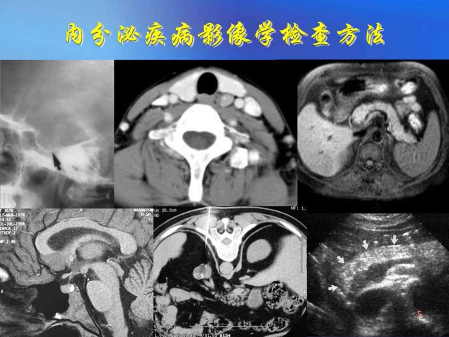 精品推荐医学影像诊断课件图文详解完整版-内分泌影ppt课件_第5页