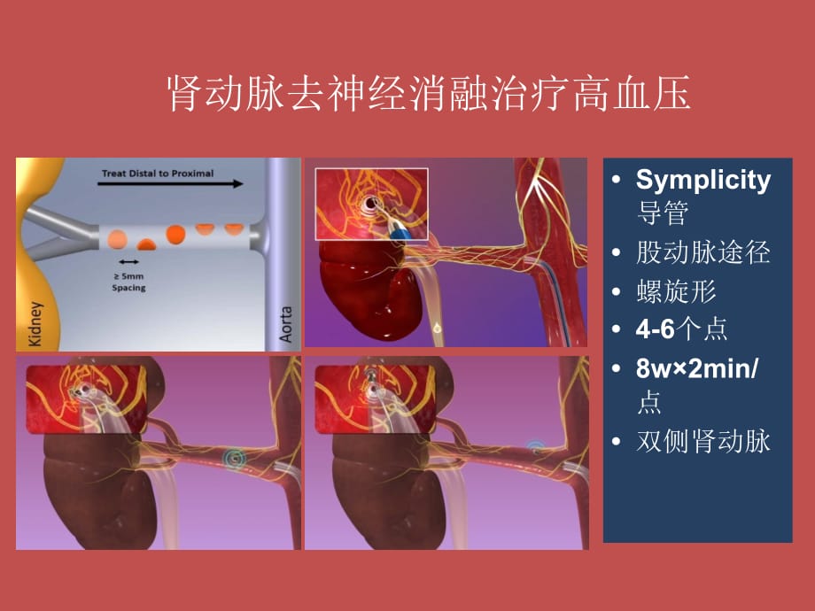 经皮肾动脉去神经消融的适应证与临床研究ppt课件_第5页