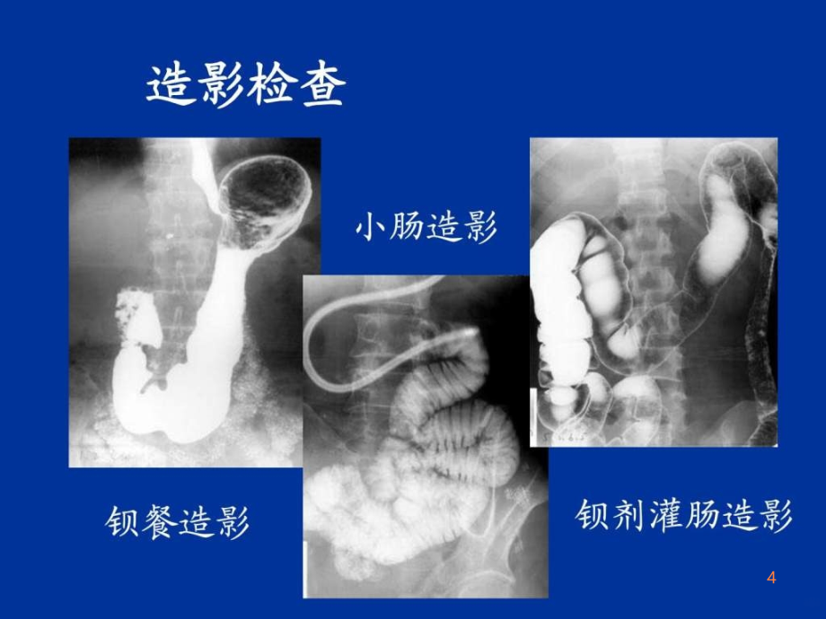 精品推荐医学影像诊断课件图文详解完整版-消化系统ppt课件_第4页