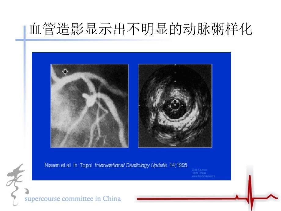 急性冠脉病症的病理机制ppt课件_第5页