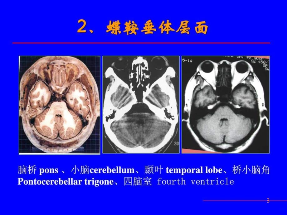 精品推荐医学影像诊断课件图文详解完整版-神经系统ppt课件_第3页